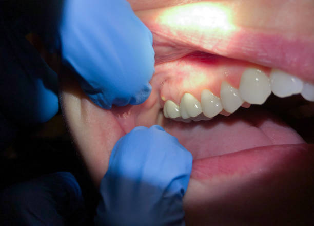 Best Emergency Dentist for Lost Fillings or Crowns in Monaca, PA